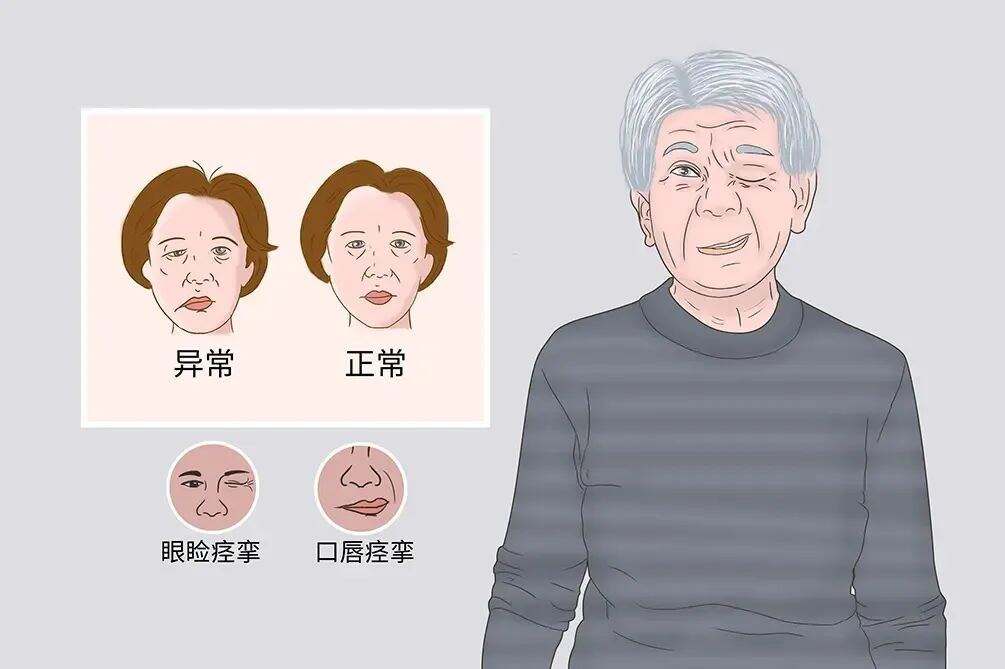 meige’s syndrome（梅杰综合征）　　嘉兴市第一医院疼痛科是浙江省省市共建